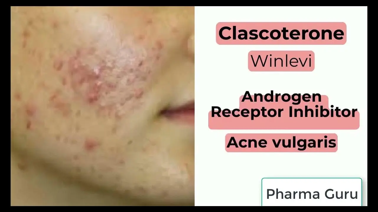 Clascoterone: Innovations in Acne Treatment